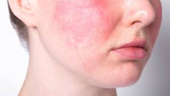 How to clear up skin after 40: a face has rosacea on the cheeks. You cannot tell the gender because the picture is from the nose down to the upper part of the neck