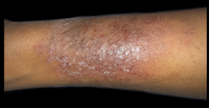 best eczema creams for african american skin