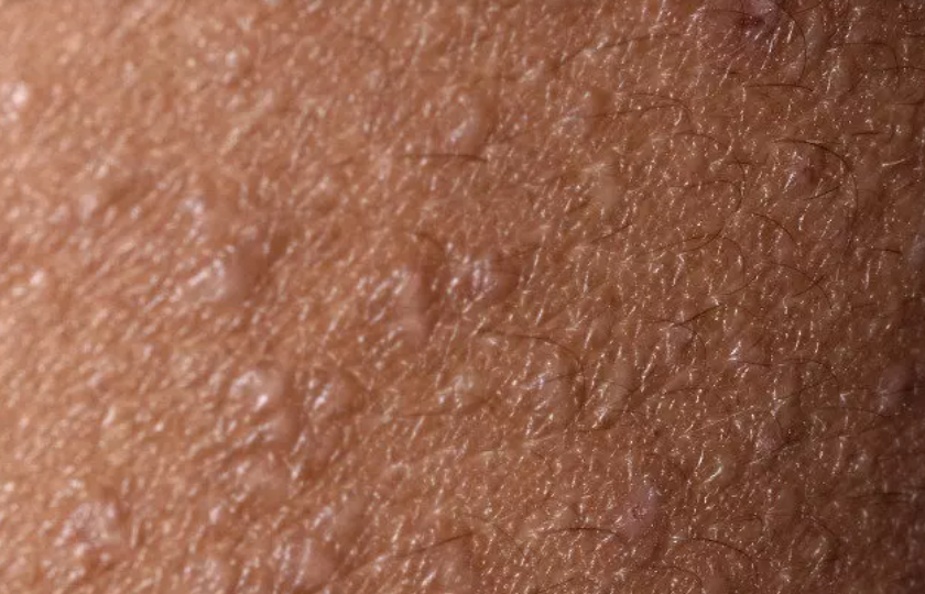 best eczema creams for African American skin - follicular eczema up close