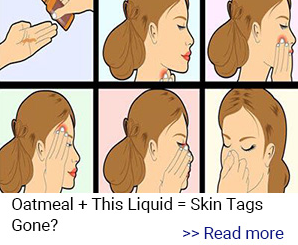 a cartoon image of how to apply the product, Revitag, to skin tags in 6 chronological frames