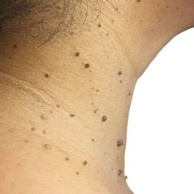 skin tags on the side of the neck